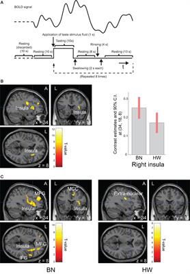 Increased Subjective Distaste and Altered Insula Activity to Umami Tastant in Patients with Bulimia Nervosa